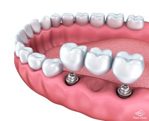 مراحل ایمپلنت دندان آسیاب