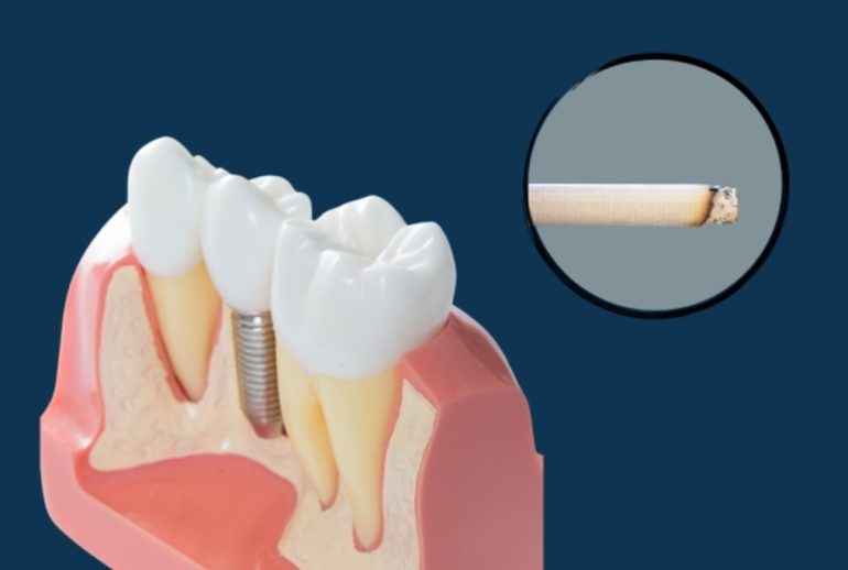 Is smoking harmful to implants?