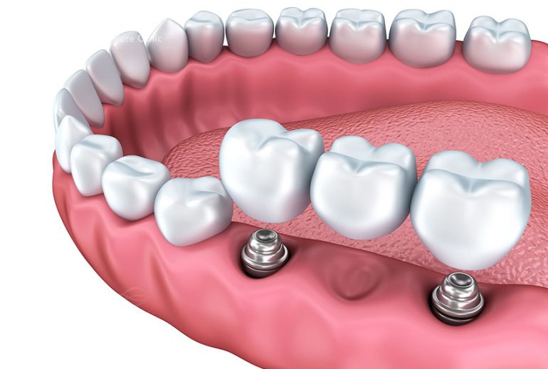 مراحل ایمپلنت دندان آسیاب